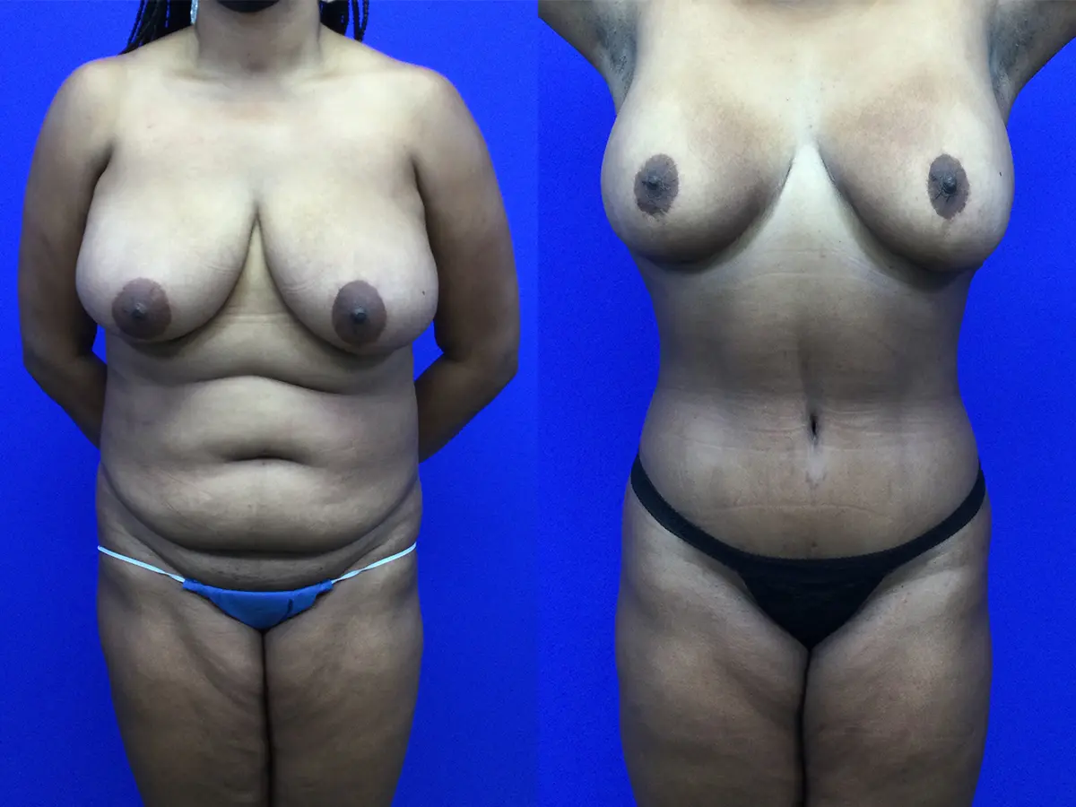 Samer W. Cabbabe, MD | Board - Certified Plastic Surgeon tummy tuck result — St. Louis, MO