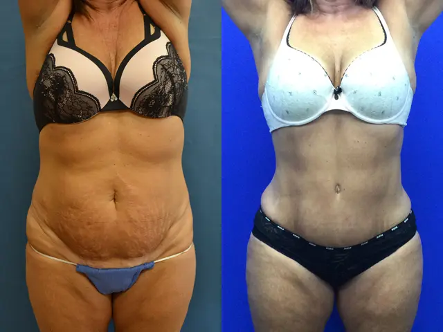 Mini Tummy Tuck result at Samer W. Cabbabe, MD | Board - Certified Plastic Surgeon in St. Louis, MO