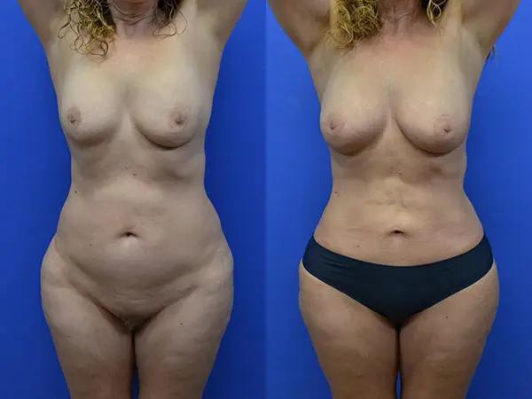 Samer W. Cabbabe, MD | Board - Certified Plastic Surgeon tummy tuck result — St. Louis, MO
