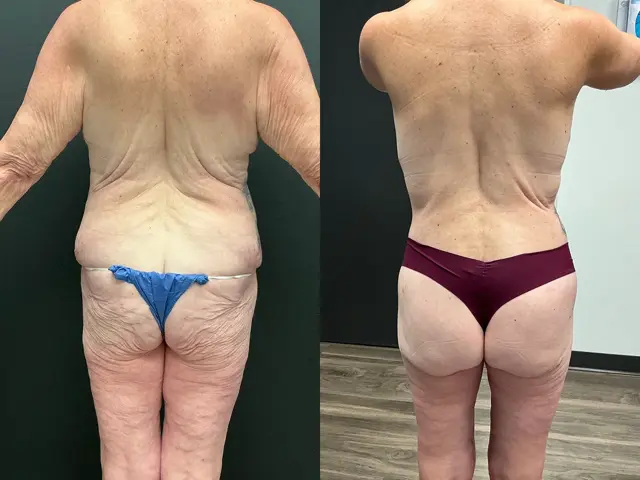 Thigh Lift result at Samer W. Cabbabe, MD | Board - Certified Plastic Surgeon in St. Louis, MO