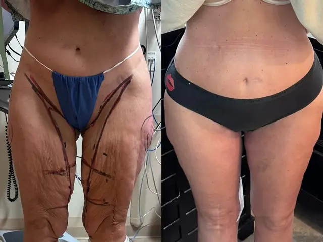 Thigh Lift result at Samer W. Cabbabe, MD | Board - Certified Plastic Surgeon in St. Louis, MO