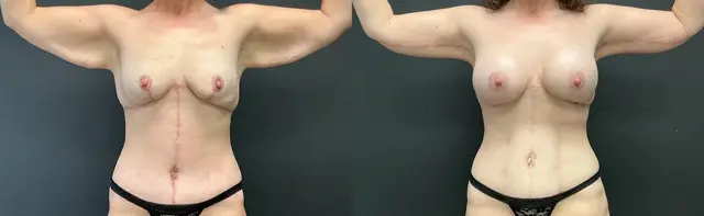 Arm Lift result at Samer W. Cabbabe, MD | Board - Certified Plastic Surgeon in St. Louis, MO