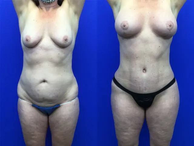 Mommy Makeover result at Samer W. Cabbabe, MD | Board - Certified Plastic Surgeon in St. Louis, MO