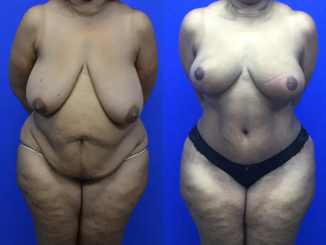 Breast Reduction result at Samer W. Cabbabe, MD | Board - Certified Plastic Surgeon in St. Louis, MO