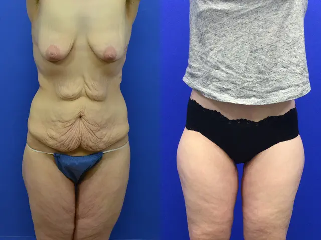 Thigh Lift result at Samer W. Cabbabe, MD | Board - Certified Plastic Surgeon in St. Louis, MO