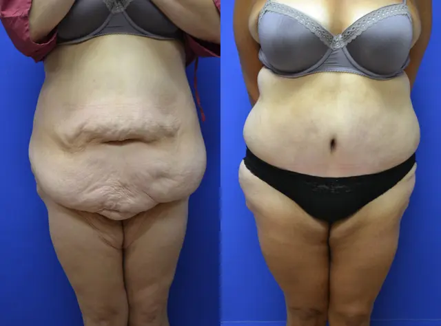 Arm Lift result at Samer W. Cabbabe, MD | Board - Certified Plastic Surgeon in St. Louis, MO