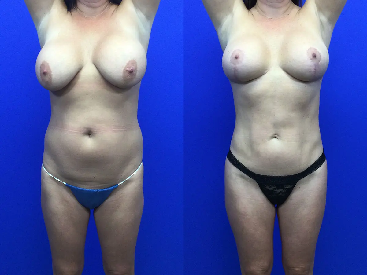 Samer W. Cabbabe, MD | Board - Certified Plastic Surgeon mommy makeover result — St. Louis, MO