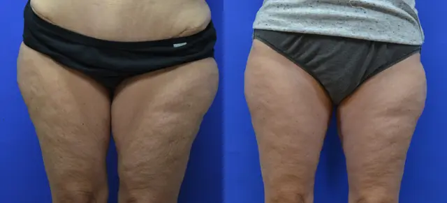 Arm Lift result at Samer W. Cabbabe, MD | Board - Certified Plastic Surgeon in St. Louis, MO
