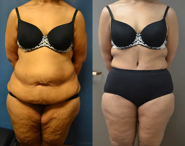 Arm Lift result at Samer W. Cabbabe, MD | Board - Certified Plastic Surgeon in St. Louis, MO