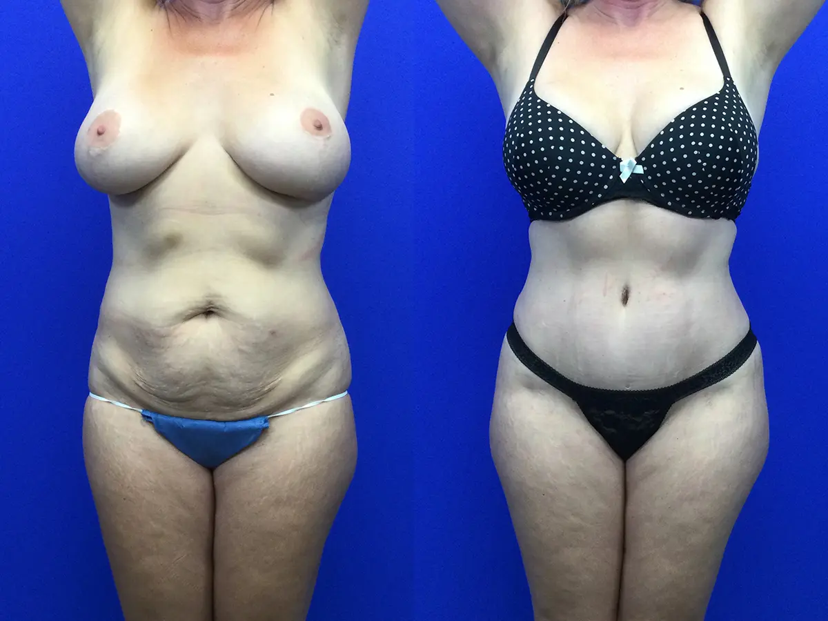 Samer W. Cabbabe, MD | Board - Certified Plastic Surgeon tummy tuck result — St. Louis, MO