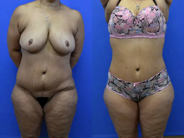 Arm Lift result at Samer W. Cabbabe, MD | Board - Certified Plastic Surgeon in St. Louis, MO