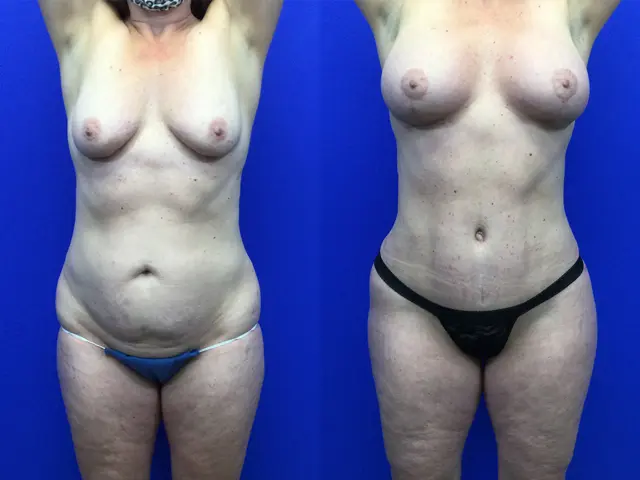 Mini Tummy Tuck result at Samer W. Cabbabe, MD | Board - Certified Plastic Surgeon in St. Louis, MO