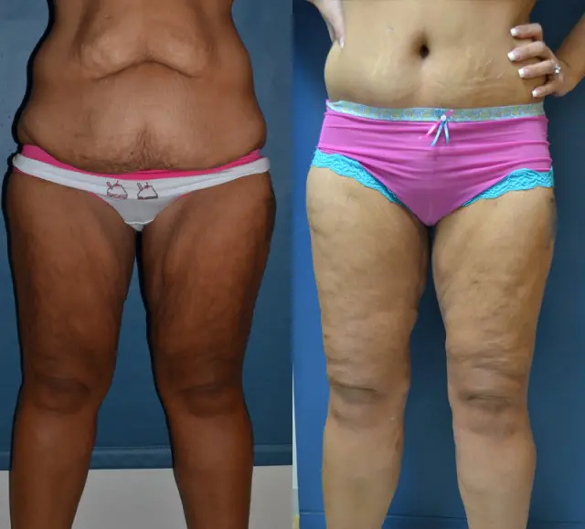 Thigh Lift result at Samer W. Cabbabe, MD | Board - Certified Plastic Surgeon in St. Louis, MO