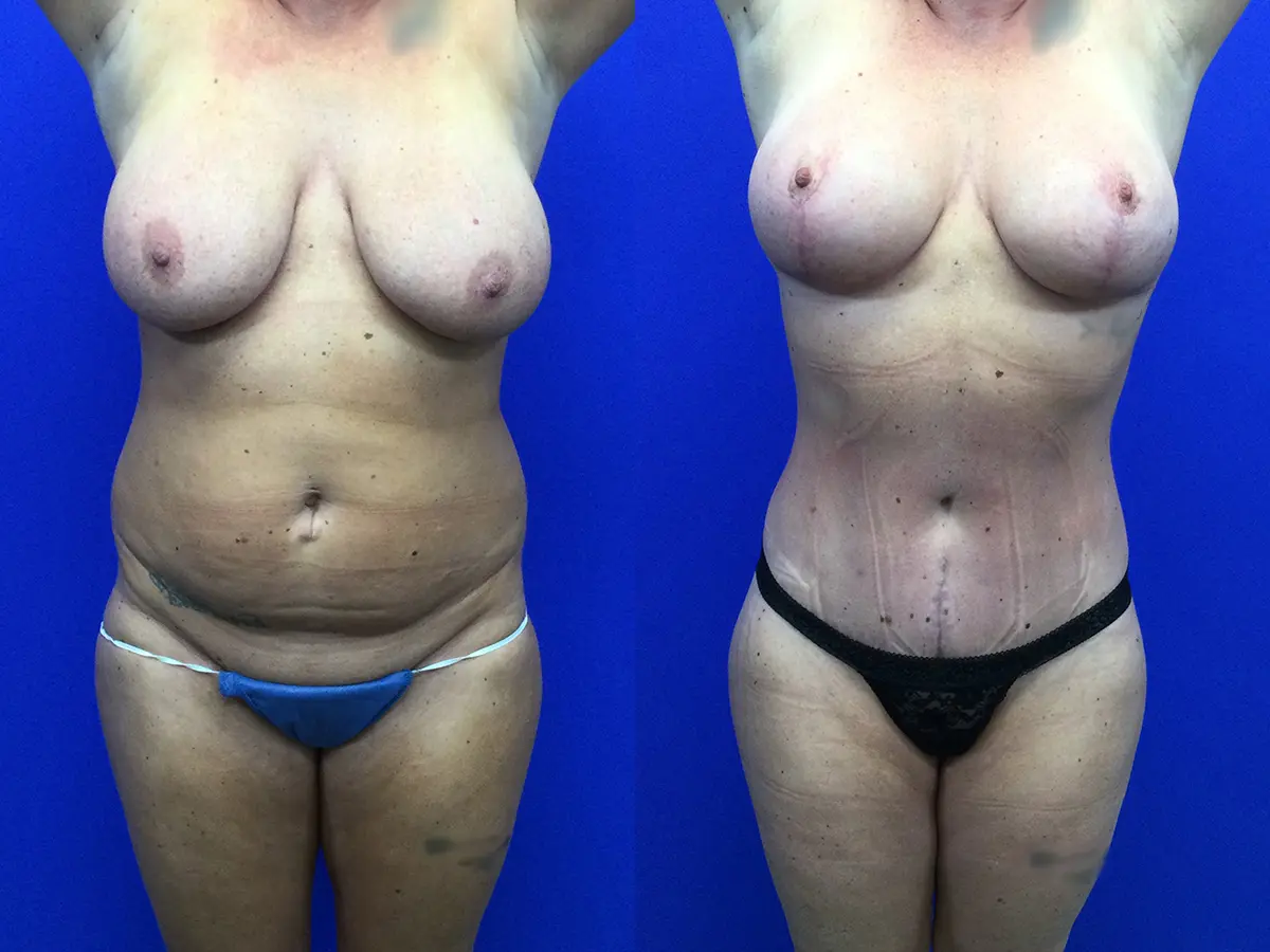 Samer W. Cabbabe, MD | Board - Certified Plastic Surgeon mommy makeover result — St. Louis, MO