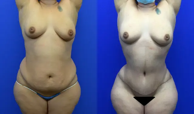 Tummy Tuck result at Samer W. Cabbabe, MD | Board - Certified Plastic Surgeon in St. Louis, MO