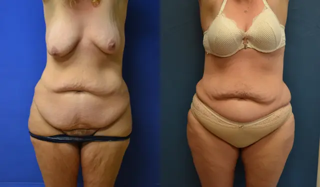 Arm Lift result at Samer W. Cabbabe, MD | Board - Certified Plastic Surgeon in St. Louis, MO