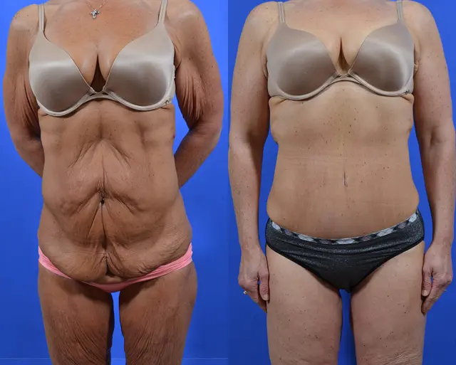 Arm Lift result at Samer W. Cabbabe, MD | Board - Certified Plastic Surgeon in St. Louis, MO