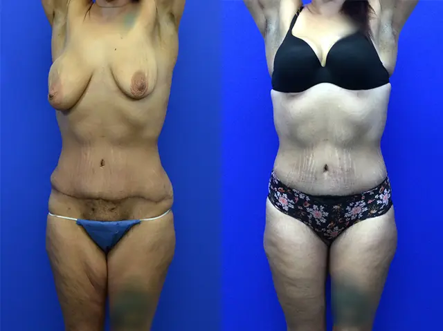 Arm Lift result at Samer W. Cabbabe, MD | Board - Certified Plastic Surgeon in St. Louis, MO