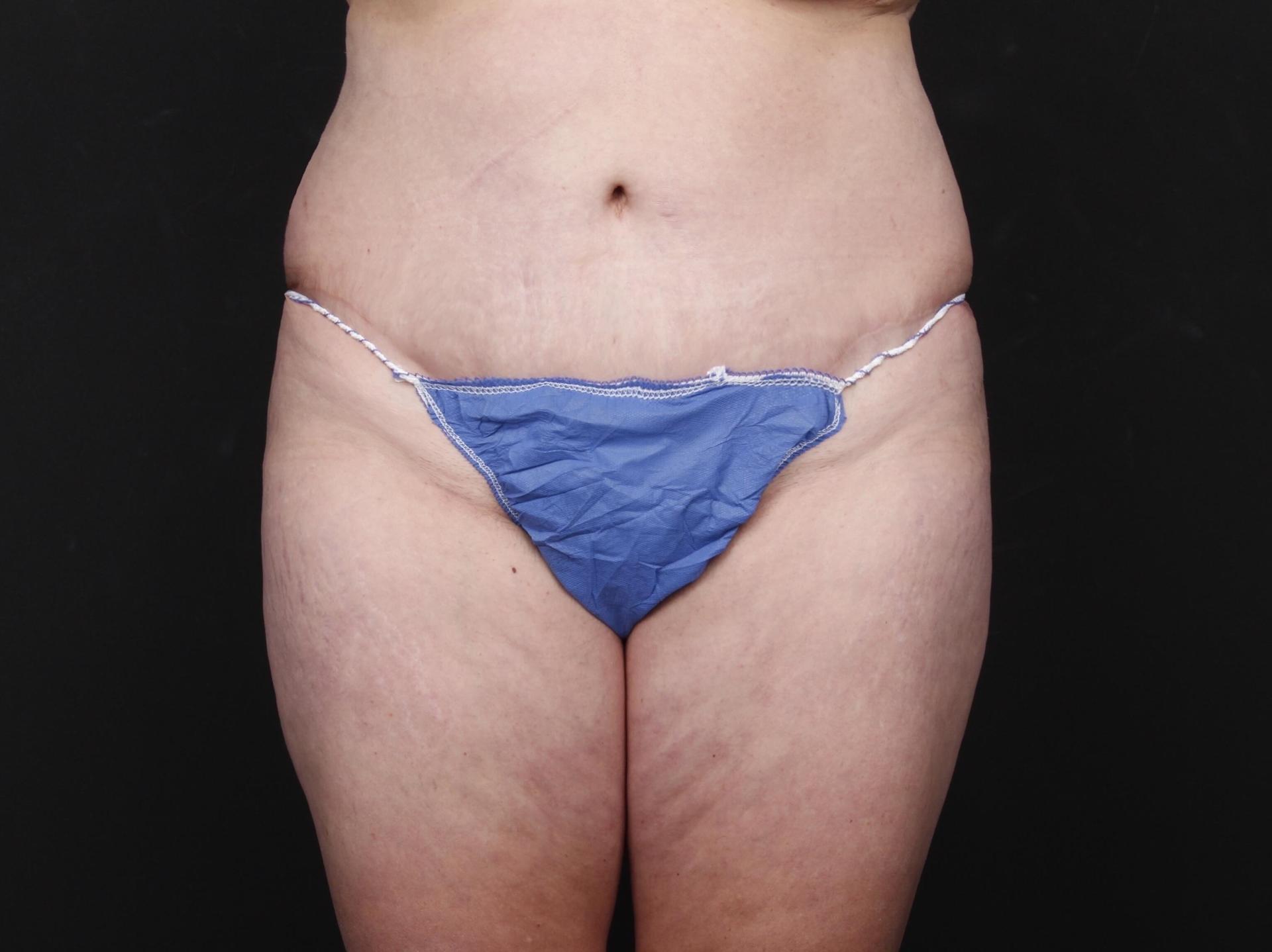 Manish C. Champaneria, MD tummy tuck after — San Diego, CA