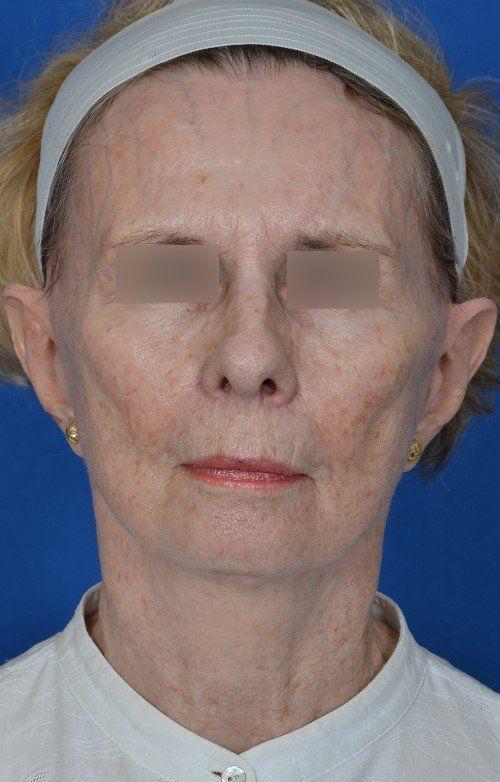 Visage Facial Plastic Surgery rhinoplasty after — Waukesha, WI