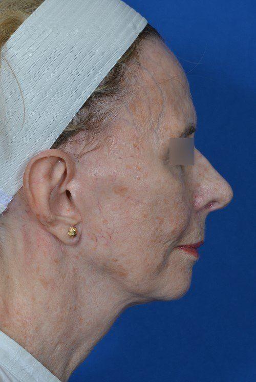 Functional Rhinoplasty after at Visage Facial Plastic Surgery in Waukesha, WI
