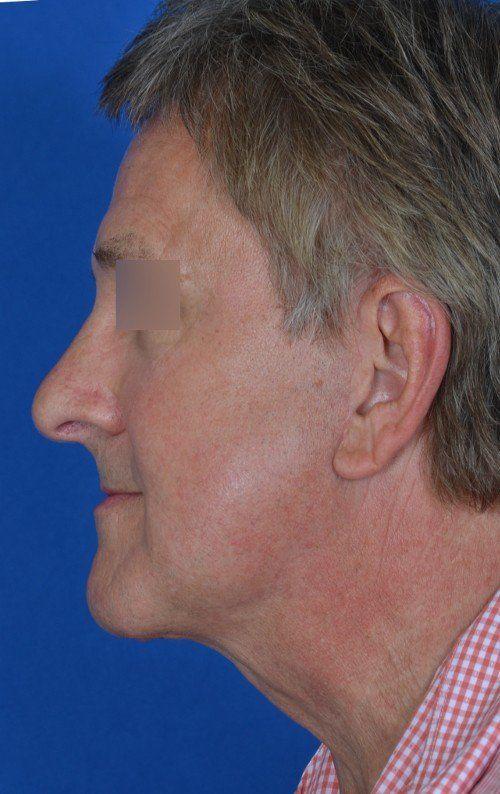 Visage Facial Plastic Surgery rhinoplasty after — Waukesha, WI