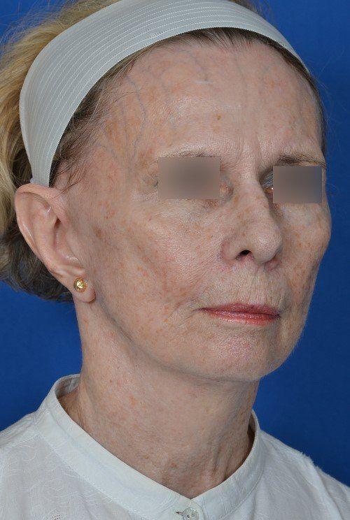Visage Facial Plastic Surgery rhinoplasty after — Waukesha, WI
