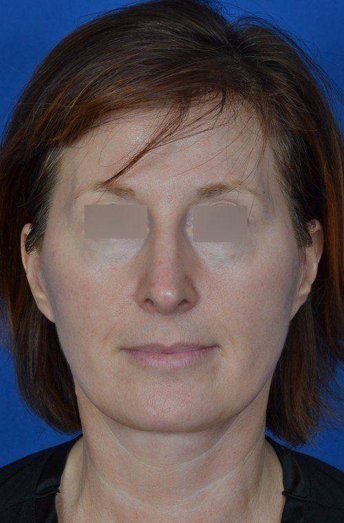 Functional Rhinoplasty after at Visage Facial Plastic Surgery in Waukesha, WI