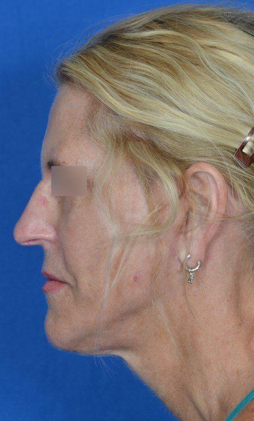 Visage Facial Plastic Surgery rhinoplasty after — Waukesha, WI