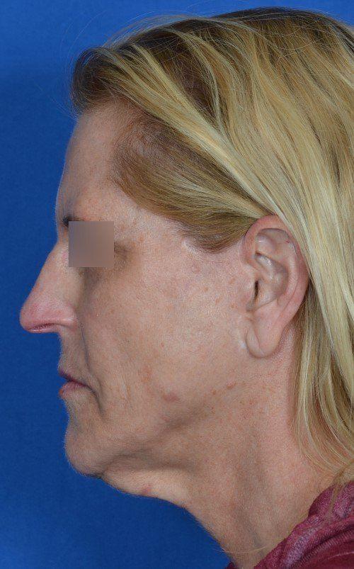 Functional Rhinoplasty before at Visage Facial Plastic Surgery in Waukesha, WI