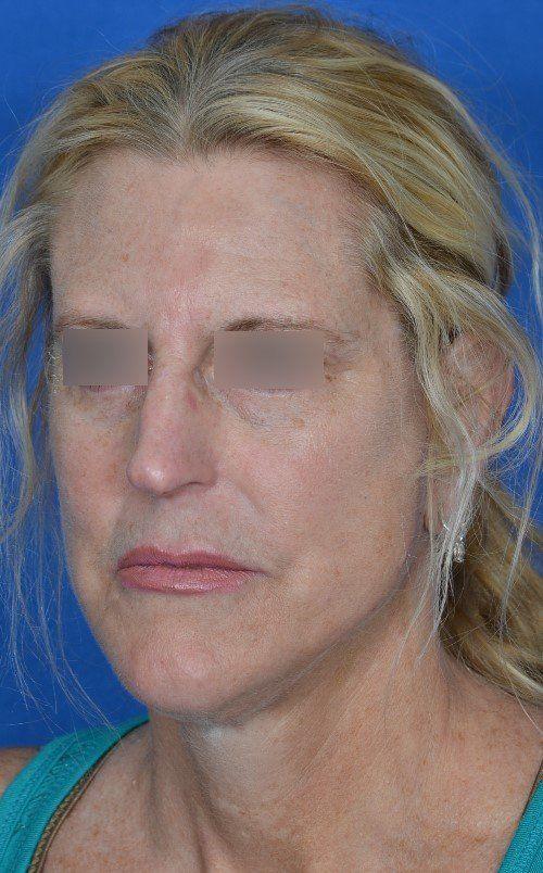 Visage Facial Plastic Surgery rhinoplasty after — Waukesha, WI