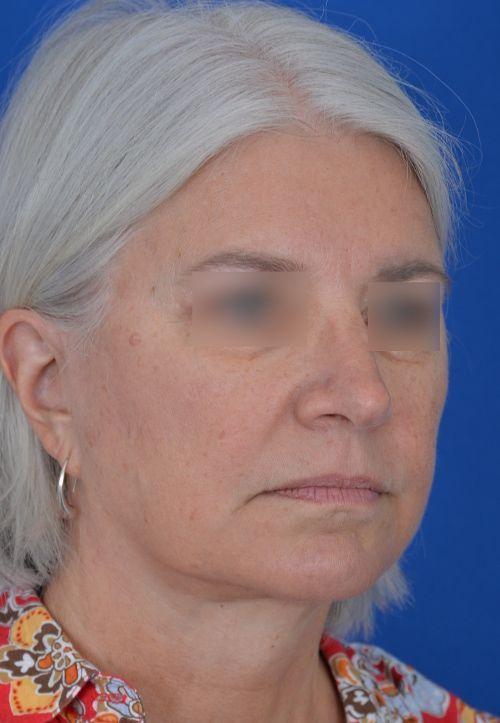Visage Facial Plastic Surgery rhinoplasty after — Waukesha, WI