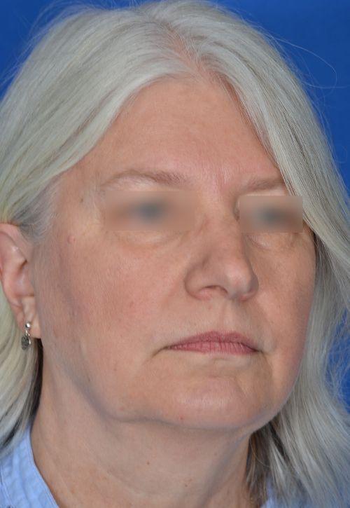 Functional Rhinoplasty before at Visage Facial Plastic Surgery in Waukesha, WI