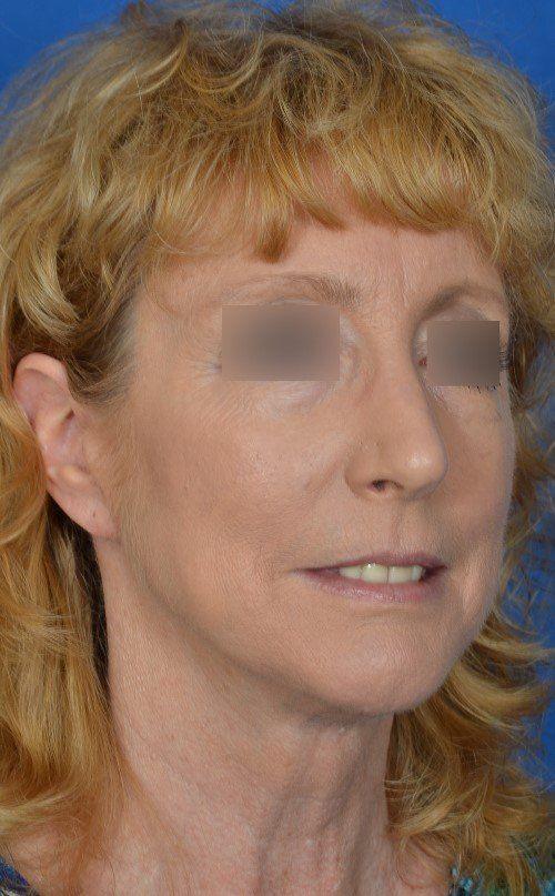 Visage Facial Plastic Surgery rhinoplasty after — Waukesha, WI