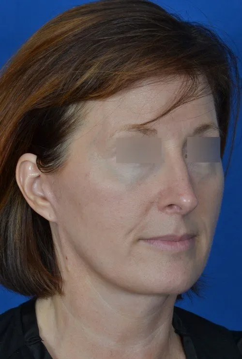 Rhinoplasty after at Visage Facial Plastic Surgery in Waukesha, WI