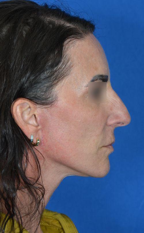 Functional Rhinoplasty after at Visage Facial Plastic Surgery in Waukesha, WI
