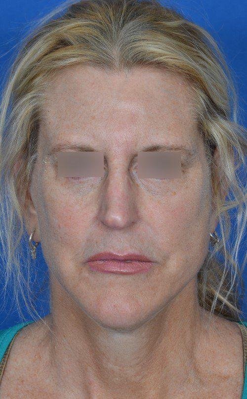 Visage Facial Plastic Surgery rhinoplasty after — Waukesha, WI