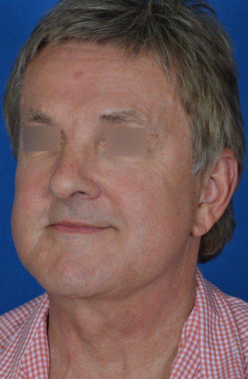 Visage Facial Plastic Surgery rhinoplasty after — Waukesha, WI
