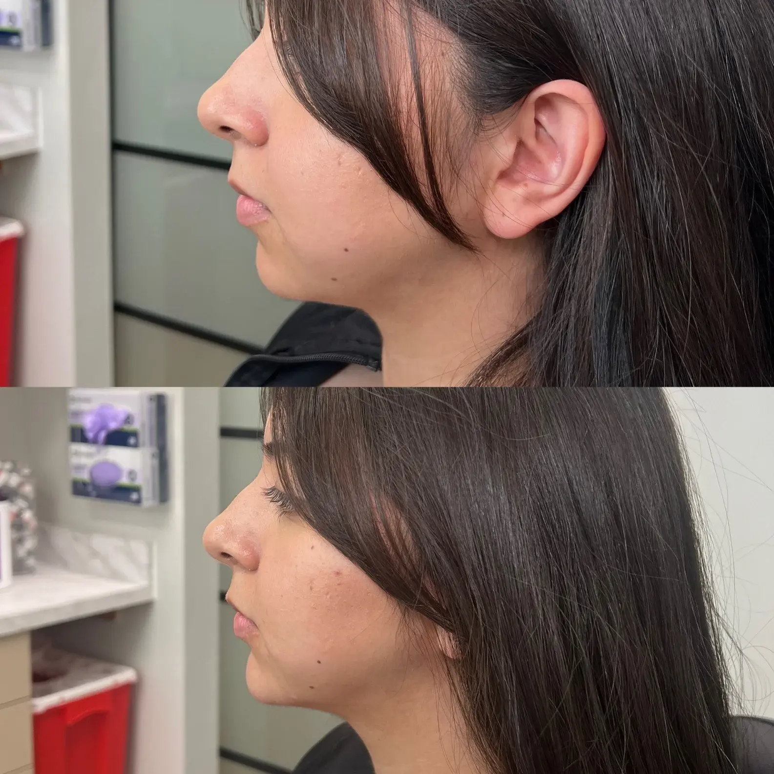 Refine KC Aesthetics lip filler result — Kansas City, MO