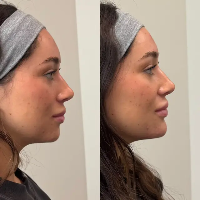 Lip Filler result at Refine KC Aesthetics in Kansas City, MO
