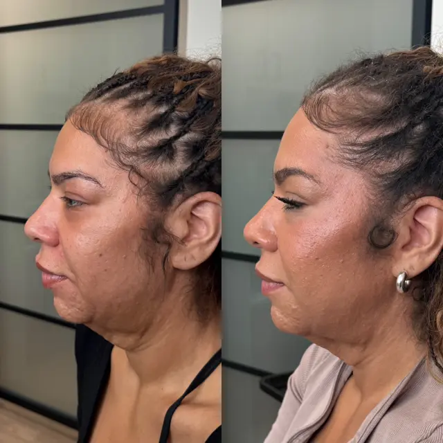 Lip Filler result at Refine KC Aesthetics in Kansas City, MO
