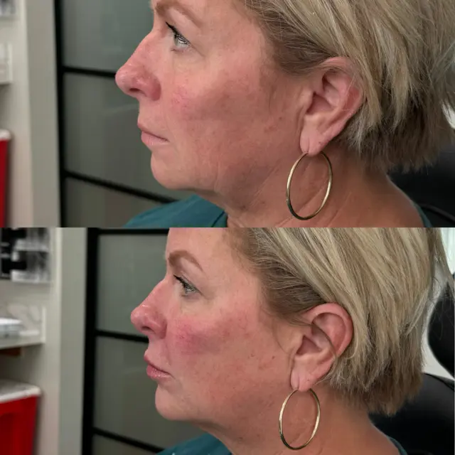 Lip Filler result at Refine KC Aesthetics in Kansas City, MO