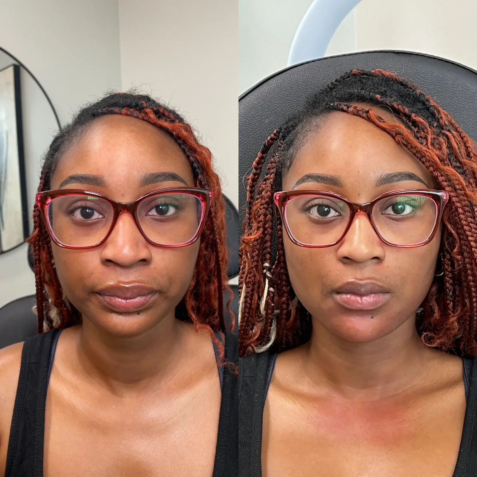 Refine KC Aesthetics lip filler result — Kansas City, MO