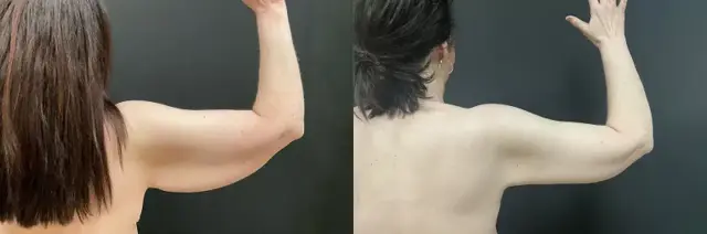 Arm Lift result at My Plastic Surgery Group in Carmel, IN