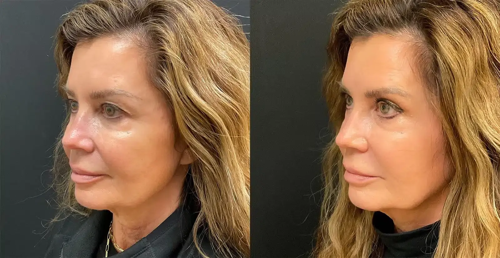 My Plastic Surgery Group eyelid lift result — Carmel, IN