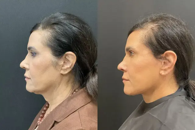 Deep Plane Facelift result at My Plastic Surgery Group in Carmel, IN