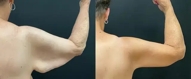 Arm Lift result at My Plastic Surgery Group in Carmel, IN