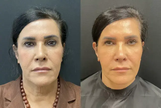 Deep Plane Facelift result at My Plastic Surgery Group in Carmel, IN