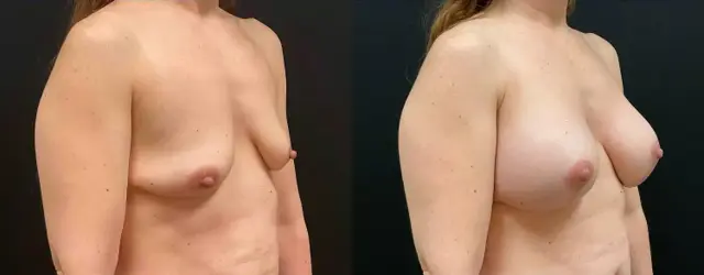 Breast Augmentation result at My Plastic Surgery Group in Carmel, IN