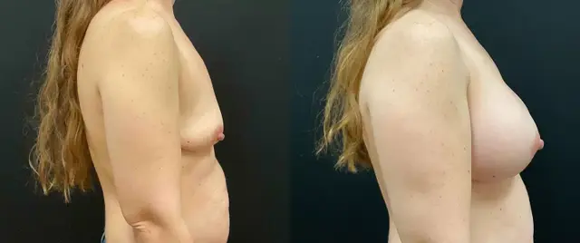 Breast Augmentation result at My Plastic Surgery Group in Carmel, IN